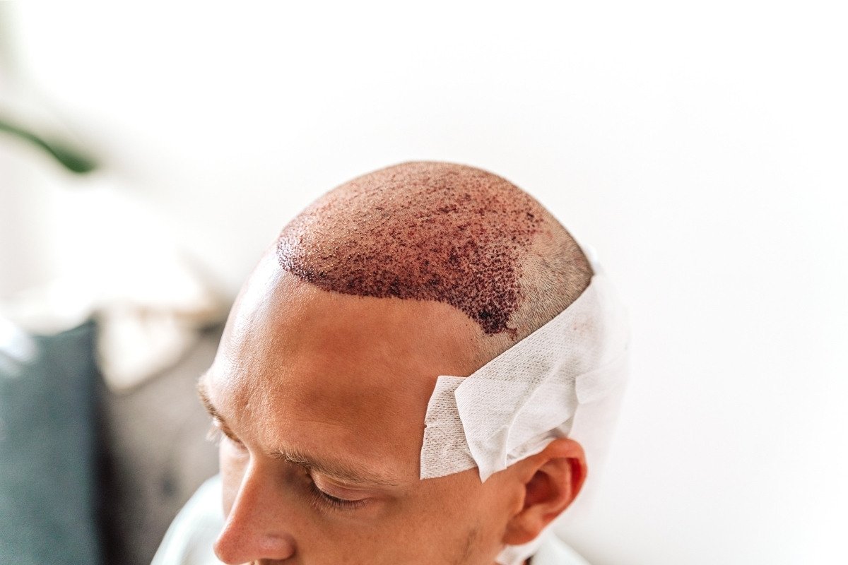 Planning Hair Transplant in turkey?